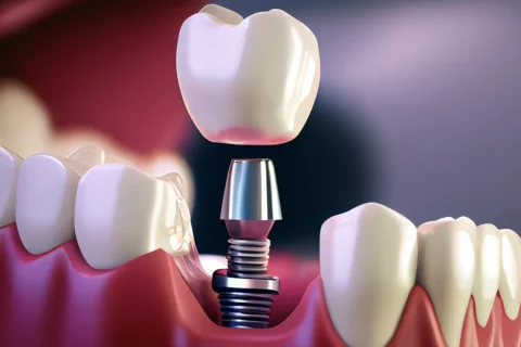 Dental İmplant Tedavisi 1 Dental İmplant Tedavisi