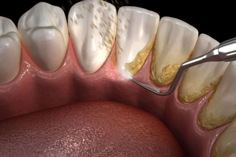 Detertraj (Diş Taşı Temizliği) 19 Detertraj (Diş Taşı Temizliği)