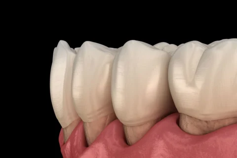 Diş Eti Küretajı (Cerrahi Temizlik) 5 Diş Eti Küretajı (Cerrahi Temizlik)