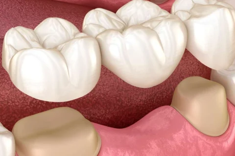 Diş Köprü Protezi 7 Diş Köprü Protezi