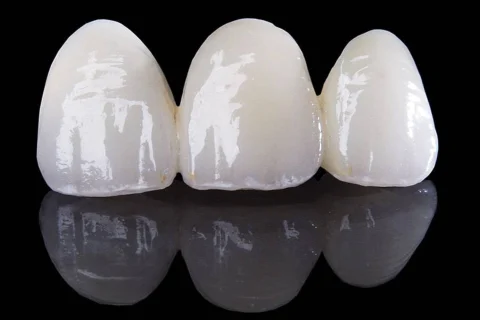 E-Max Porselen Kaplama 9 E-Max Porselen Kaplama