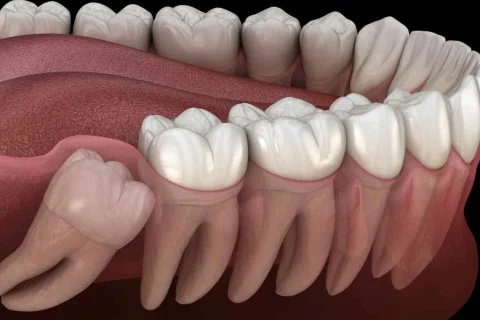 Gömülü 20 Yaş Dişi Çekimi 3 Gömülü 20 Yaş Dişi Çekimi