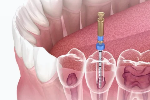 Kanal Tedavisi 14 Kanal Tedavisi