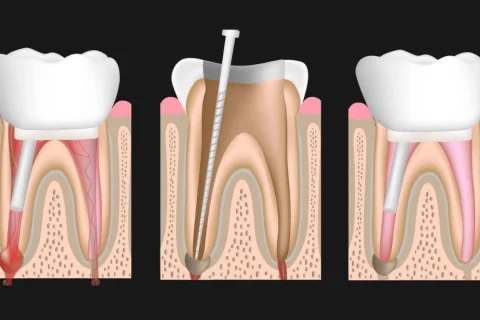 Kanal Tedavisi Yenileme (Retreatment) 15 Kanal Tedavisi Yenileme (Retreatment)