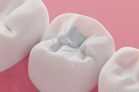 Kompozit Dolgu (Beyaz Dolgu) 16 Kompozit Dolgu (Beyaz Dolgu)