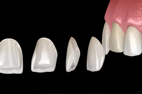 Lamine Kaplama (Yaprak Porselen) 6 Lamine Kaplama (Yaprak Porselen)