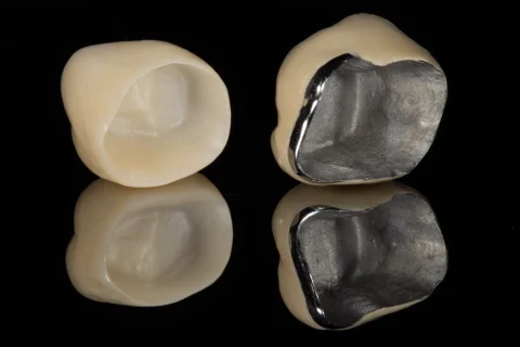 Metal Destekli Porselen Kaplama 10 Metal Destekli Porselen Kaplama