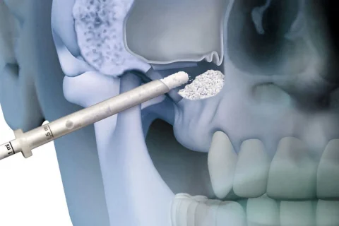 Sinüs Lifting ve Sinüs Operasyonları 4 Sinüs Lifting ve Sinüs Operasyonları